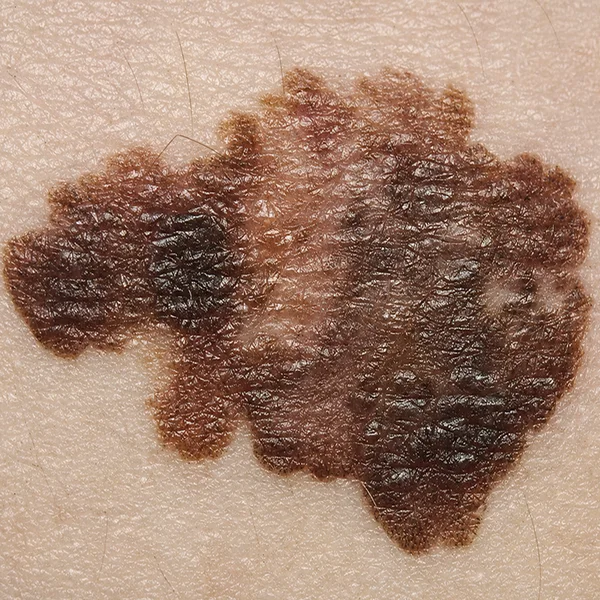 Melanoma: lesión de contorno asimétrico