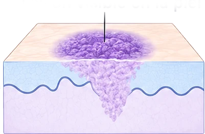 Corte de piel con la lesión pigmentada visible en la epidermis y su extensión hacia la dermis