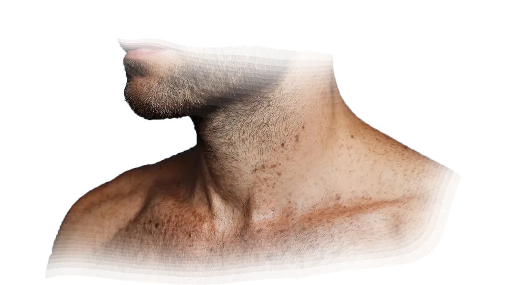 Piel de cuello y hombro con múltiples nevos pigmentados